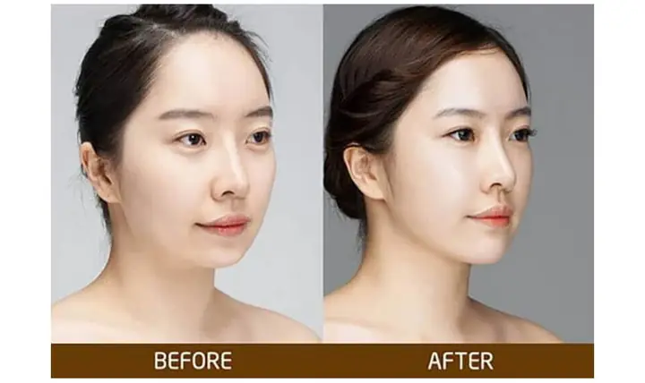 Tướng Cằm Lẹm