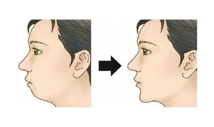 Tướng Cằm Thụt Vào
