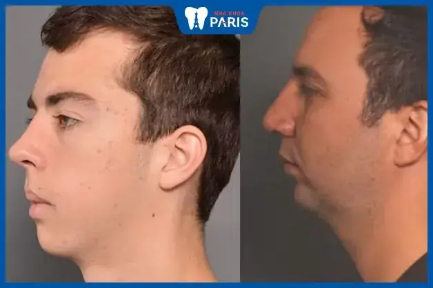 Tướng Cổ Ngắn