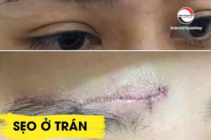 Tướng Có Sẹo Ở Trán Tướng Có Sẹo Ở Trán
