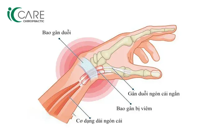 Tướng Cổ Tay Nhỏ Tướng Cổ Tay Nhỏ