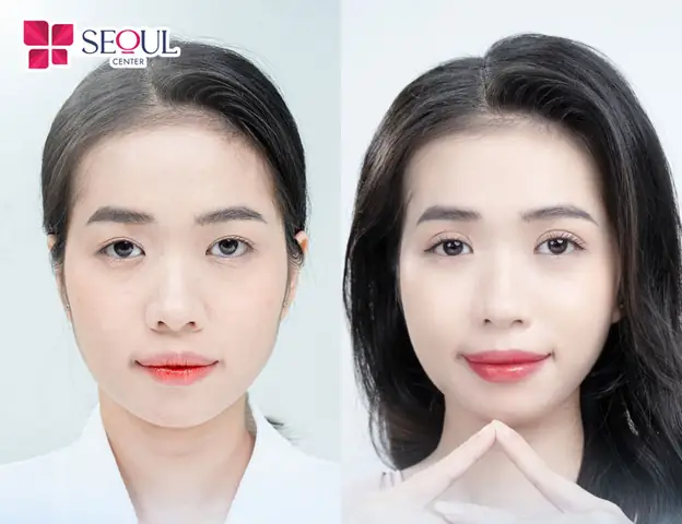 Tướng Con Gái Có Bọng Mắt Cười