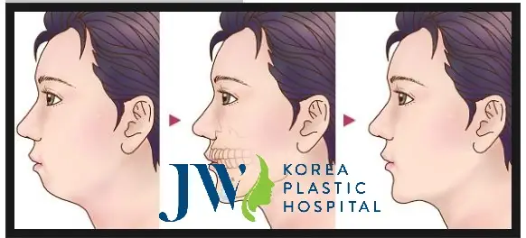 Tướng Đàn Ông Cằm Lẹm