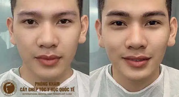 Tướng Đàn Ông Không Có Lông Mày Tướng Đàn Ông Không Có Lông Mày