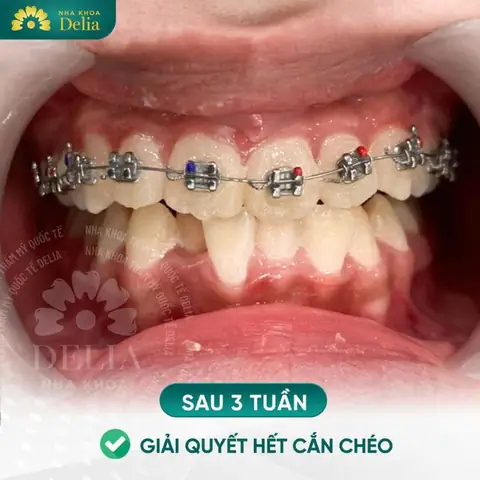 Tướng Đàn Ông Răng Hô