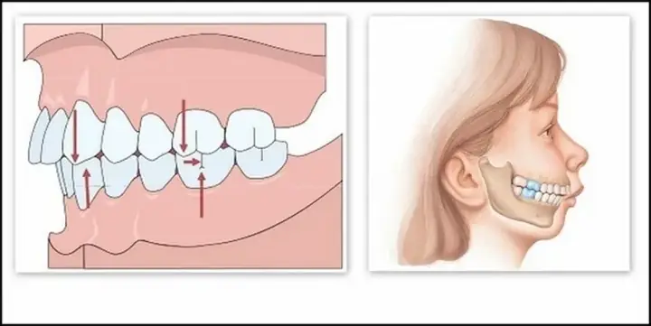 Tướng Đàn Ông Răng Quặp