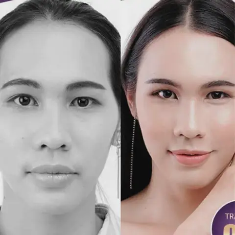 Tướng Đàn Ông Thái Dương Hóp