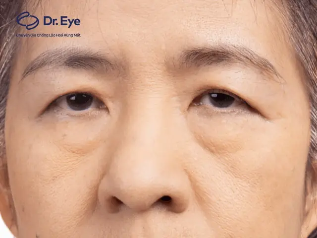 Tướng Đuôi Mắt Cụp Xuống