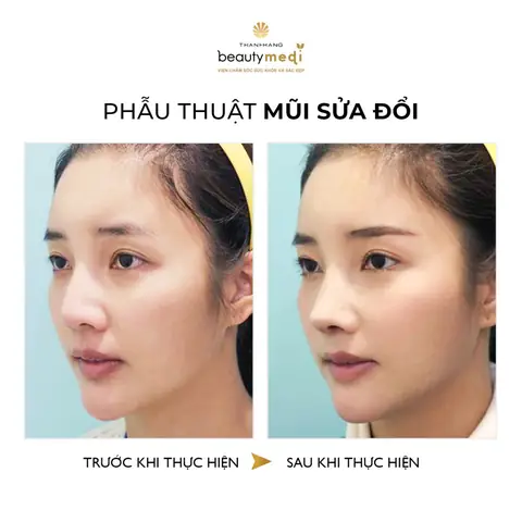 Tướng Lỗ Mũi Hở