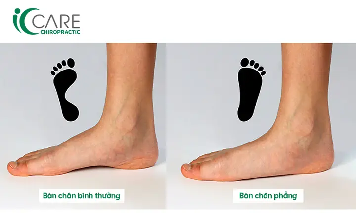 Tướng Lòng Bàn Chân Bằng Phẳng