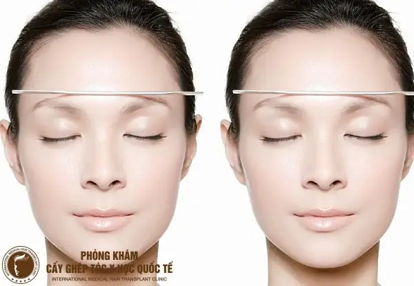 Tướng Lông Mày Không Cân Xứng