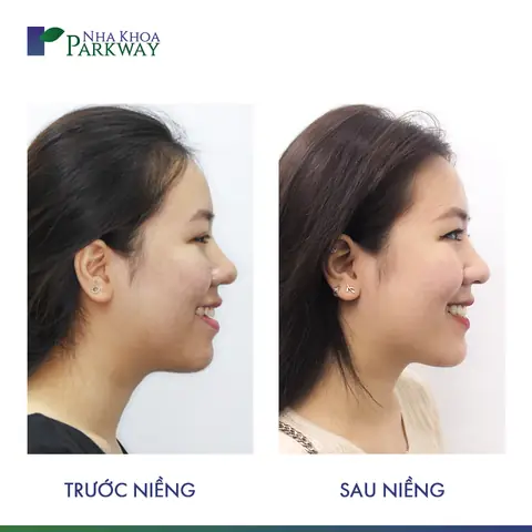 Tướng Miệng Móm