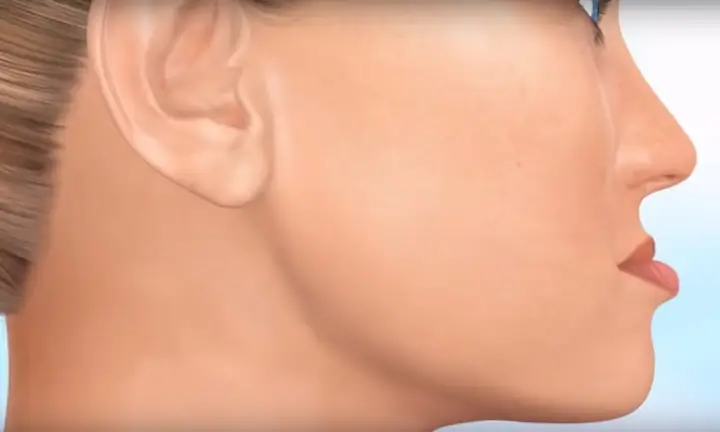 Tướng Miệng Móm