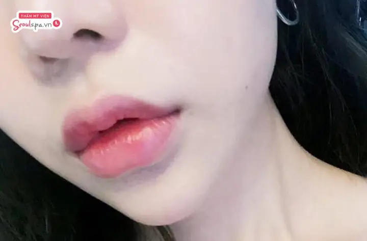 Tướng Môi Hạt Đậu