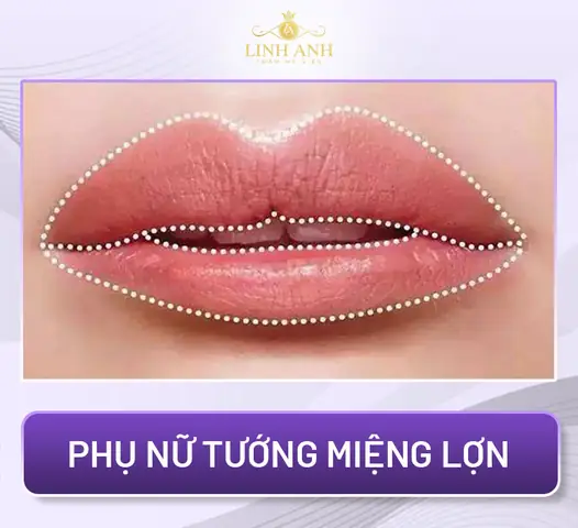 Tướng Môi Trên Cong Lên