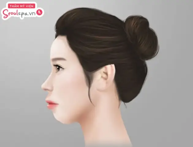 Tướng Môi Trên Nhô Ra