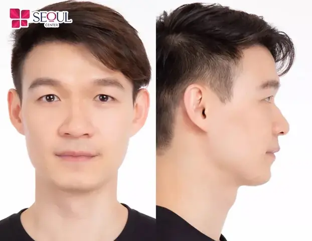 Tướng Mũi Đàn Ông Nghèo