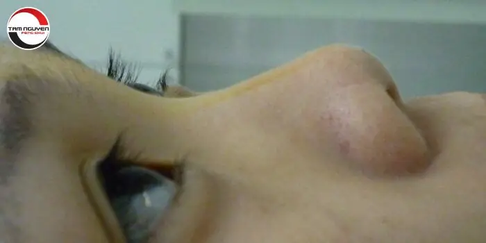 Tướng Mũi Hếch Phụ Nữ