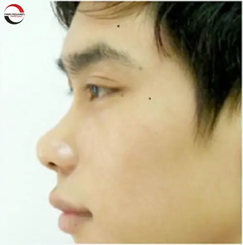 Tướng Mũi Tẹt
