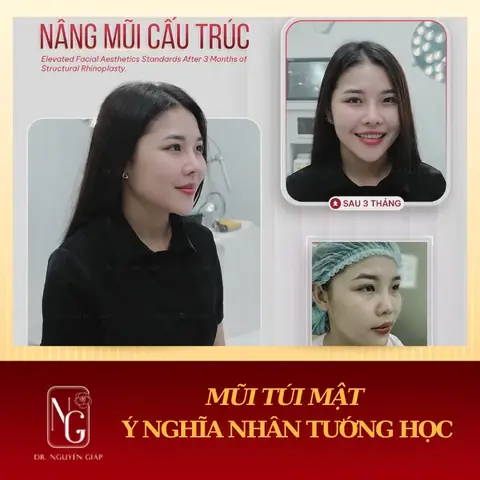 Tướng Mũi Túi Mật