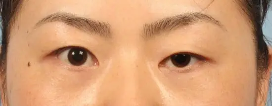 Tướng Người 2 Mí Mắt Không Đều