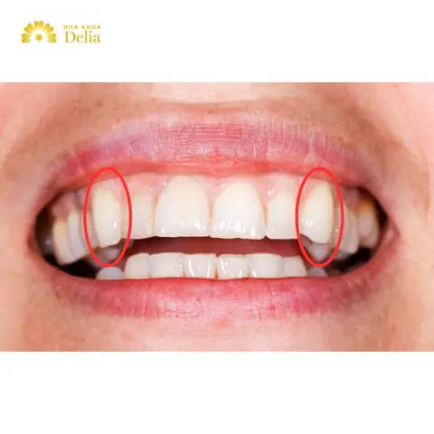 Tướng Người Có 2 Răng Nanh Nhọn