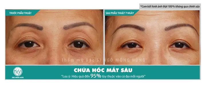 Tướng Người Có Hốc Mắt Sâu Tướng Người Có Hốc Mắt Sâu