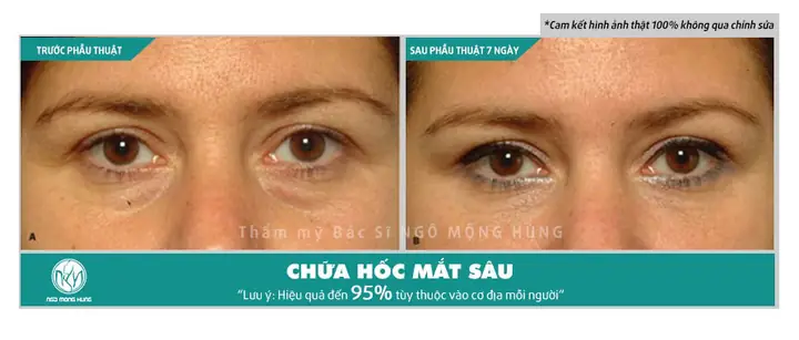 Tướng Người Có Hốc Mắt Sâu Tướng Người Có Hốc Mắt Sâu