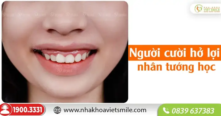 Tướng Người Cười Hở Lợi Nam