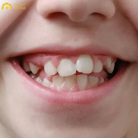 Tướng Người Răng Chuột Tướng Người Răng Chuột
