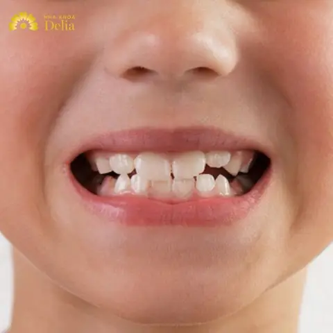 Tướng Người Răng Chuột Tướng Người Răng Chuột