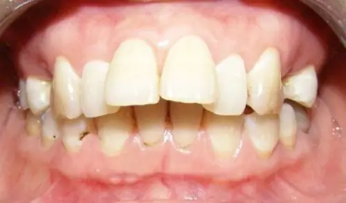 Tướng Người Răng Vẩu Tướng Người Răng Vẩu
