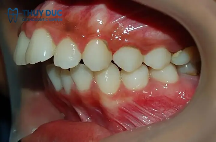 Tướng Người Răng Vẩu