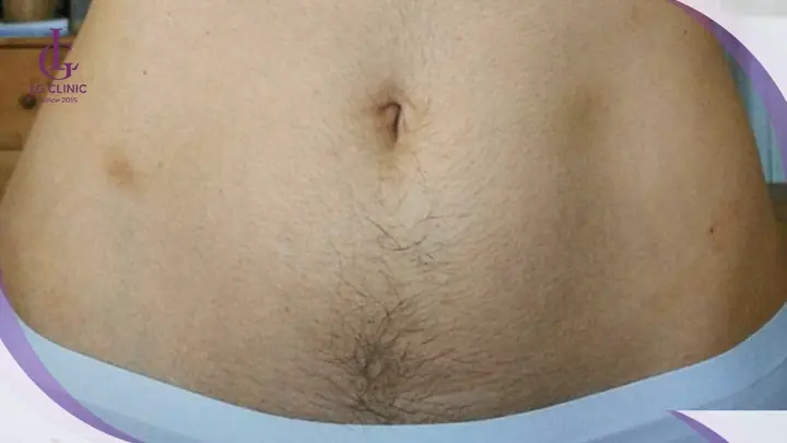Tướng Phụ Nữ Bụng Dưới To