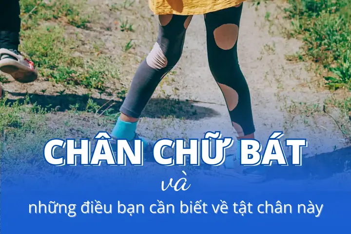 Tướng Phụ Nữ Chân Đi Chữ Bát