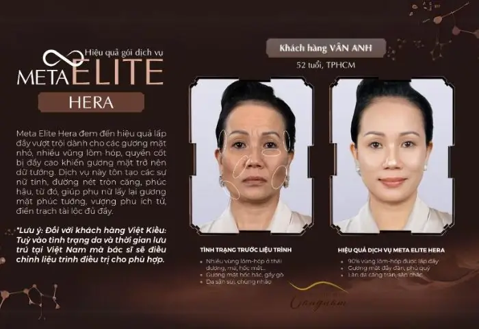 Tướng Phụ Nữ Mặt Quắt Tai Dơi