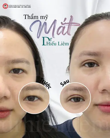 Tướng Phụ Nữ Mắt Sụp Mí