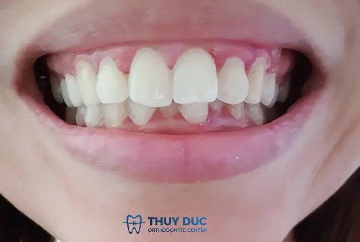 Tướng Phụ Nữ Răng Cửa To Tướng Phụ Nữ Răng Cửa To