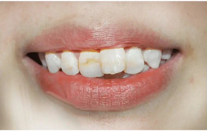 Tướng Phụ Nữ Răng Không Đều