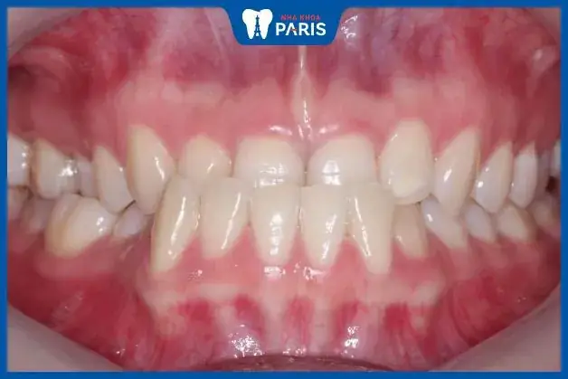 Tướng Phụ Nữ Răng Không Đều