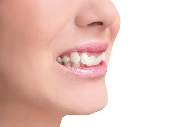 Tướng Phụ Nữ Răng Quặp