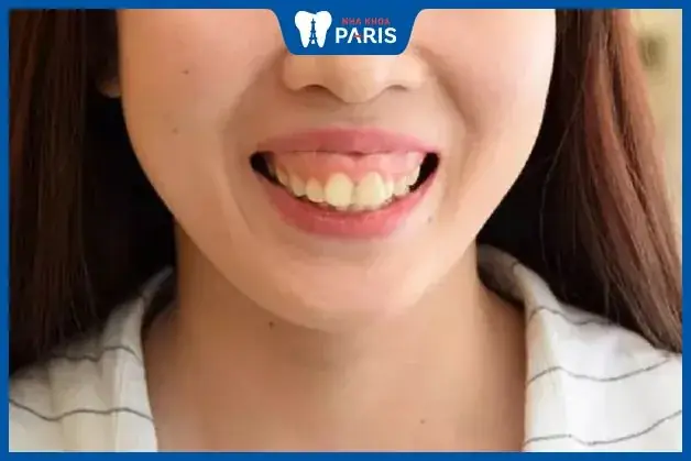 Tướng Phụ Nữ Răng To