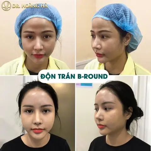 Tướng Phụ Nữ Trán Ngắn