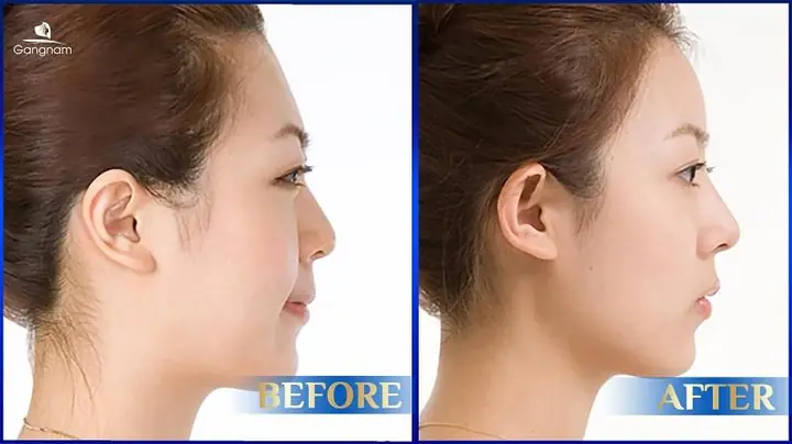 Tướng Phụ Nữ Trán Ngắn