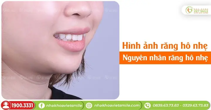 Tướng Răng Hô Nhẹ