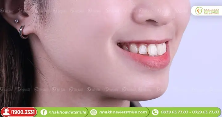 Tướng Răng Hô Nhẹ