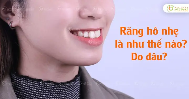Tướng Răng Hô Nhẹ
