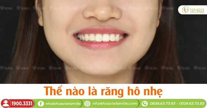 Tướng Răng Hô Nhẹ
