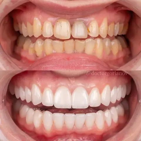 Tướng Răng Nhỏ Đều Tướng Răng Nhỏ Đều