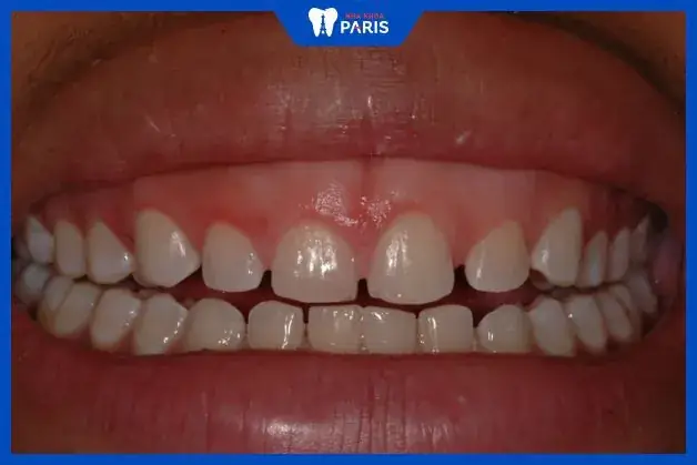 Tướng Răng Nhỏ Đều Tướng Răng Nhỏ Đều